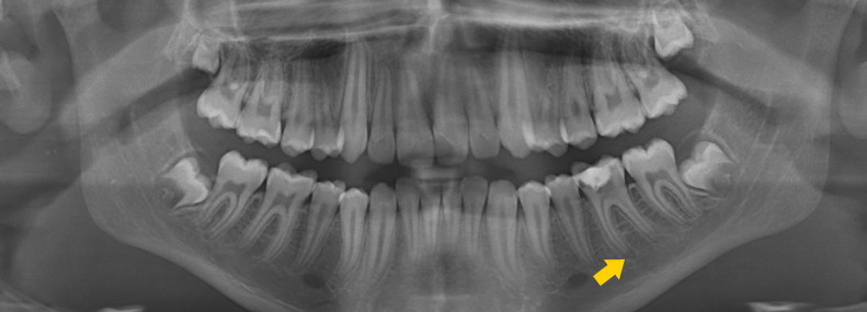 Mikroskopische Wurzelkanalbehandlung Aschaffenburger Zentrum Fur Implantologie Und Kieferchirurgie Dr Mathy Und Kollegen